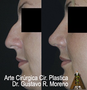 Dr. Gustavo R Moreno | Rinoplastia Rio de Janeiro e Brasília | Tratamento da Rinomegalia: nariz grande Rinoplastia Rio de Janeiro e Brasília: imagem mostrando dorso nasal e nariz grande tratados com rinoplastia estética