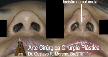 Rinoplastia Rio de Janeiro e Brasília: Imagem mostrando o tamanho da incisão na rinoplastia aberta estruturada