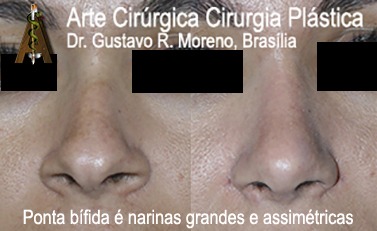 Dr. Gustavo R Moreno | Rinoplastia Rio de Janeiro e Brasília | Rinoplastia estético-funcional Rinoplastia Rio de Janeiro e Brasília: imagem mostrando paciente com narinas grandes e ponta nasal bífida