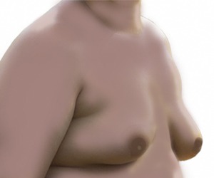 Mamoplastia Masculina (ginecomastia) | Dr. Gustavo R Moreno Rio de Janeiro e Brasília Mamoplastia Masculina (ginecomastia) | Dr. Gustavo R Moreno Rio de Janeiro e Brasília
