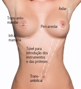 Vias de acesso para colocação de próteses de mama Rio de Janeiro e Brasília