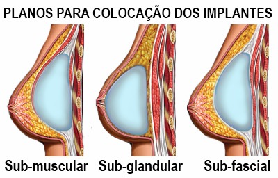 Planos para a colocação de próteses de mama Rio de Janeiro e Brasília