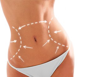 LIpoabdominoplastia Rio de Janeiro e Brasília