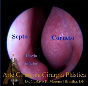 Rinoplastia Rio de Janeiro e Brasília: Rinoscopia mostrando desvio do septo nasal e hipertrofia de cornetos