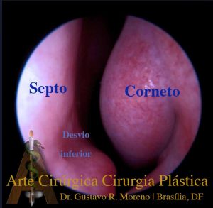 Dr. Gustavo R. Moreno | Rinoplastia Rio de Janeiro e Brasília: Rinoscopia Rinoplastia Rio de Janeiro e Brasília: Rinoscopia mostrando desvio do septo nasal e hipertrofia de cornetos