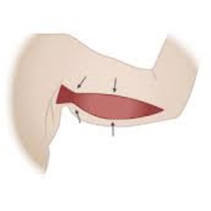 Braquioplastia, plastica dos braços Rio de Janeiro e Brasília