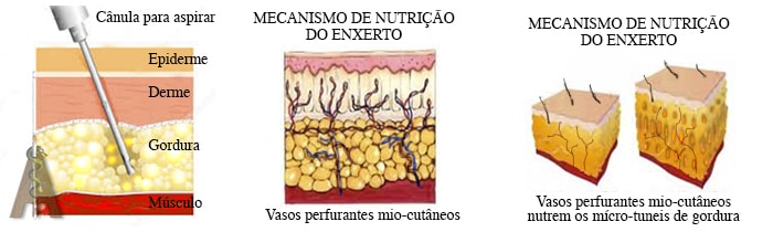 lipoescultura ou lipoplastia estruturada