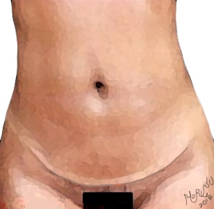 mini-abdominoplastia Rio de Janeiro e Brasilia