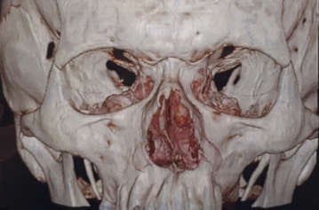Rinoplastia Rio de Janeiro e Brasília: desvio do Septo Nasal Rinoplastia Rio de Janeiro e Brasília. Imagem de tomografia com reconstrução 3D mostrando desvio do Septo Nasal