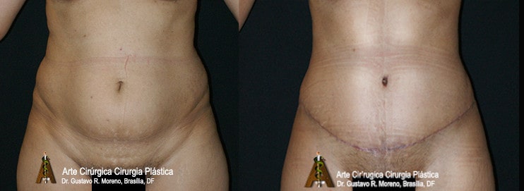 Dr. Gustavo R. Moreno | Abdominoplastia Rio de Janeiro e Brasília: imagem mostrando o tamanho da cicatriz abdominal Abdominoplastia Rio de Janeiro e Brasília: imagem mostrando o tamanho da cicatriz abdominal