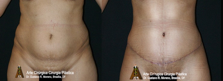 Abdominoplastia Rio de Janeiro e Brasília: imagem mostrando o tamanho da cicatriz abdominal