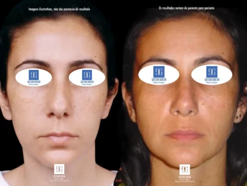 Rinosseptopastia feminina Rio de Janeiro giba nasal | Dr. Gustavo Rincon