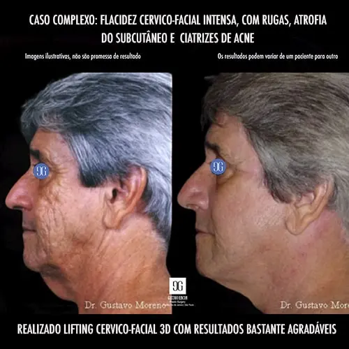 Lifting facial masculino no Rio de Janeiro | Dr. Gustavo Rincon | Caso difícil: flacidez serviço-facial extrema, atrofia subcutânea e cicatrizes de acne