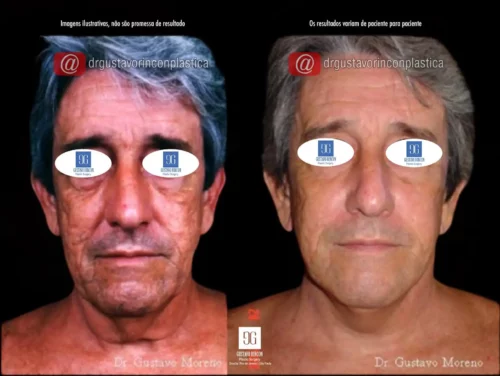 Lifting facial 3D masculino no Rio de Janeiro | Dr. Gustavo Rincon Moreno | Resultados naturais