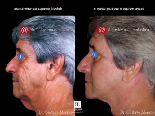 Lifting facial 3D masculino no Rio de Janeiro | Dr. Gustavo Rincon Moreno | Resultados naturais