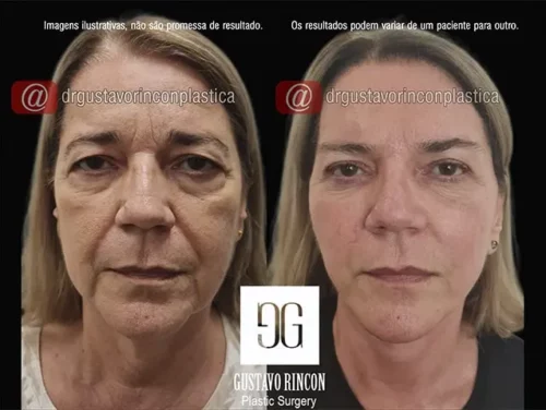 Lifting facial 3D no Rio de Janeiro | Dr. Gustavo Rincon Moreno | Resultados Naturais e de longa duração