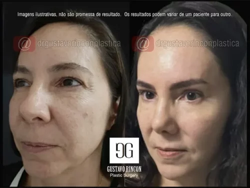 O lifting facial 3D aumenta sua beleza natural - Dr. Gustavo Rincon - Cirurgião Plástico