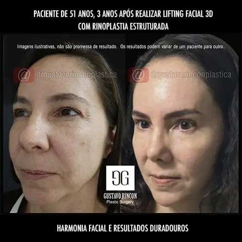 Lifitng facial mais rinoplastia no Rio de Janeiro, o verdadeiro rejuvenescimento facial - Dr. Gustavo Rincon Moreno, Cirurgiao plástico