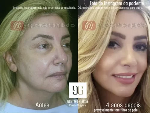 O lifting facial 3D aumenta sua beleza natural - Dr. Gustavo Rincon - Cirurgião Plástico