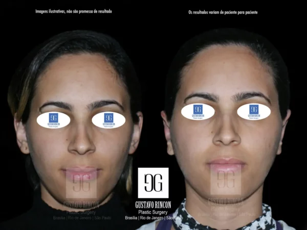Otoplastia feminina Rio de Janeiro com resultados naturais | Dr. Gustavo Rincon | Cirurgião Plástico