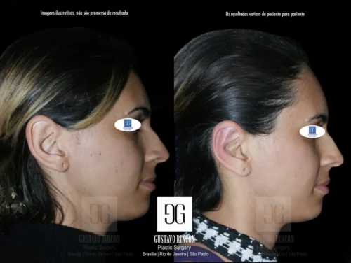Otoplastia feminina Rio de Janeiro com resultados naturais | Dr. Gustavo Rincon | Cirurgião Plástico