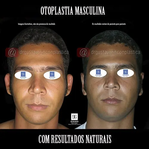 Otoplastia masculina no Rio de Janeiro com resultados naturais | Dr. Gustavo Rincon | Cirurgião Plástico