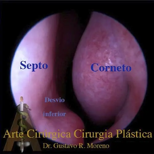 Rinoplastia Rio de Janeiro | Dr. Gustavo Rincon Moreno | Rinoplastia estética e funcional na mesma cirurgia